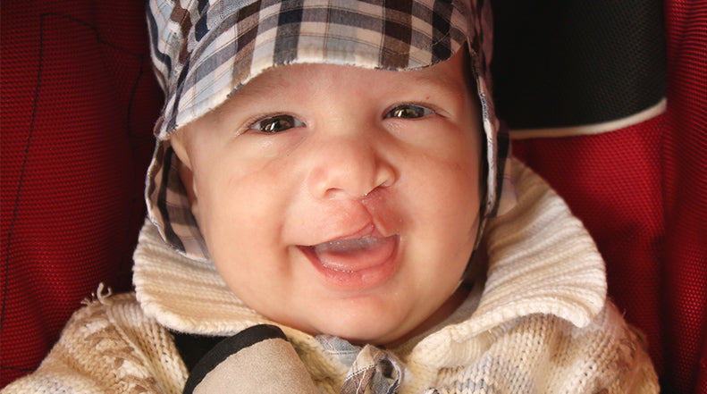 Cleft Palate Recovery