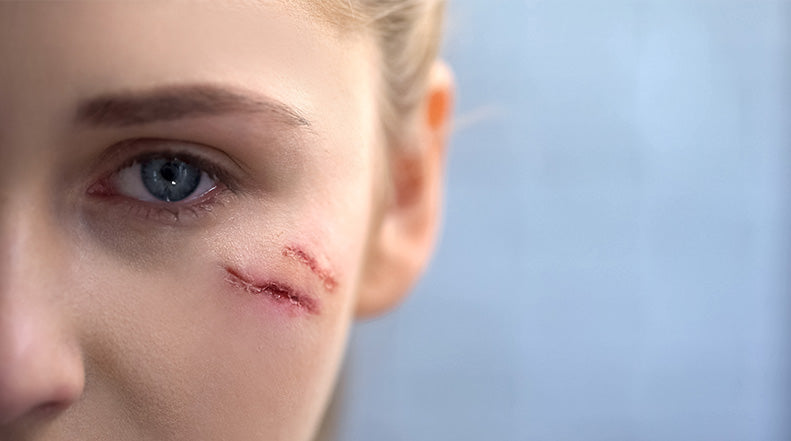 How to Minimize Facial Scarring