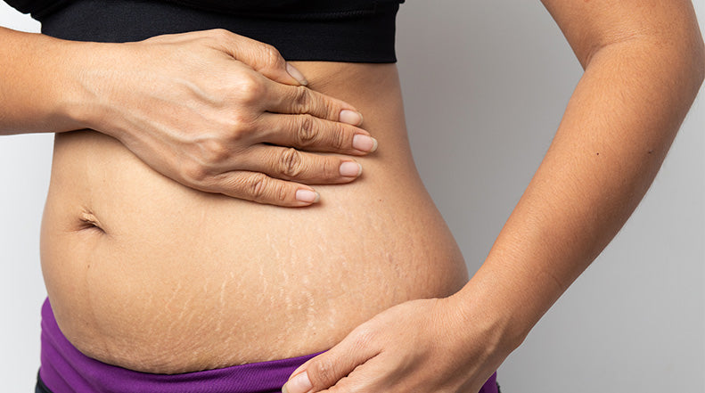 How to Treat Stretch Marks