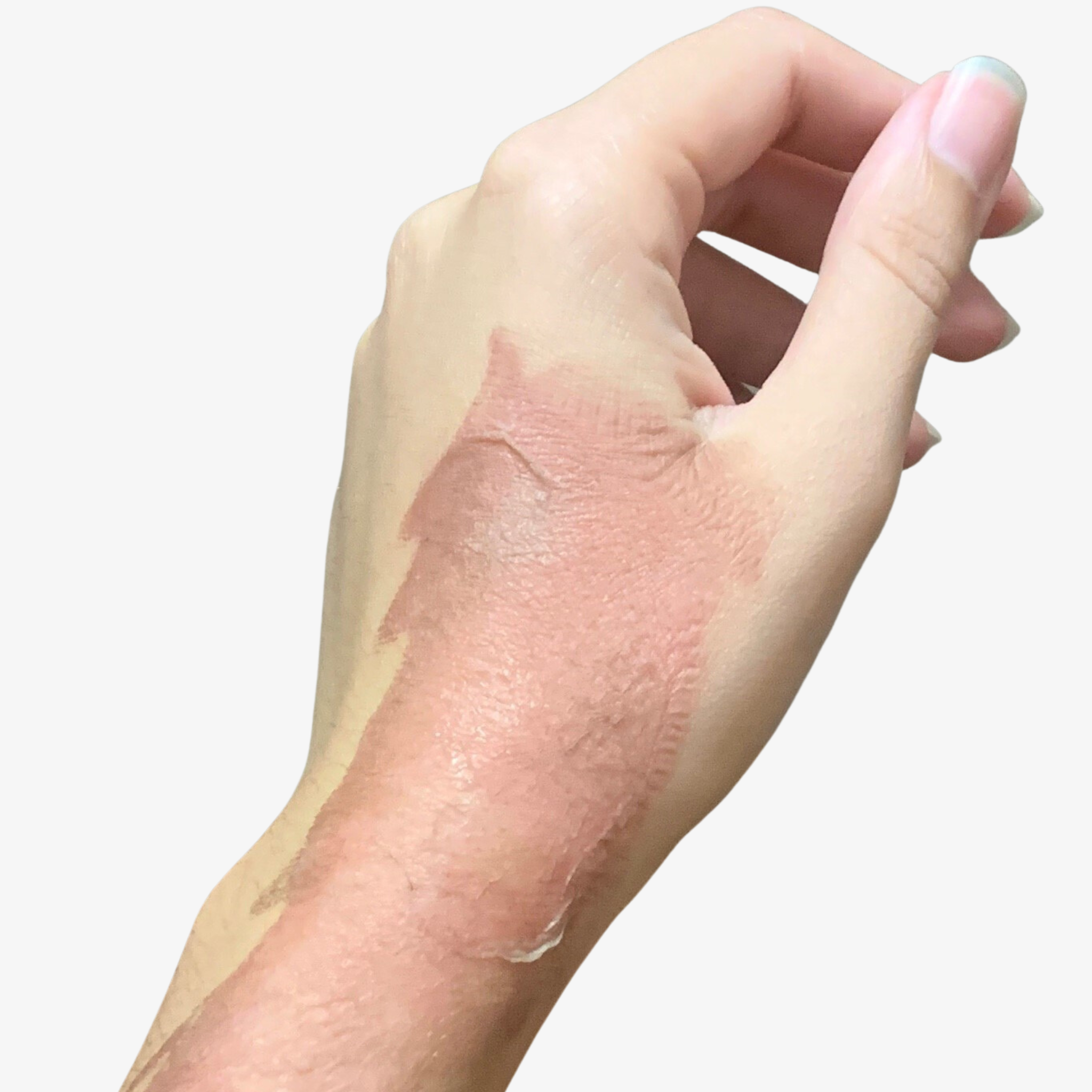 burn scar on hand