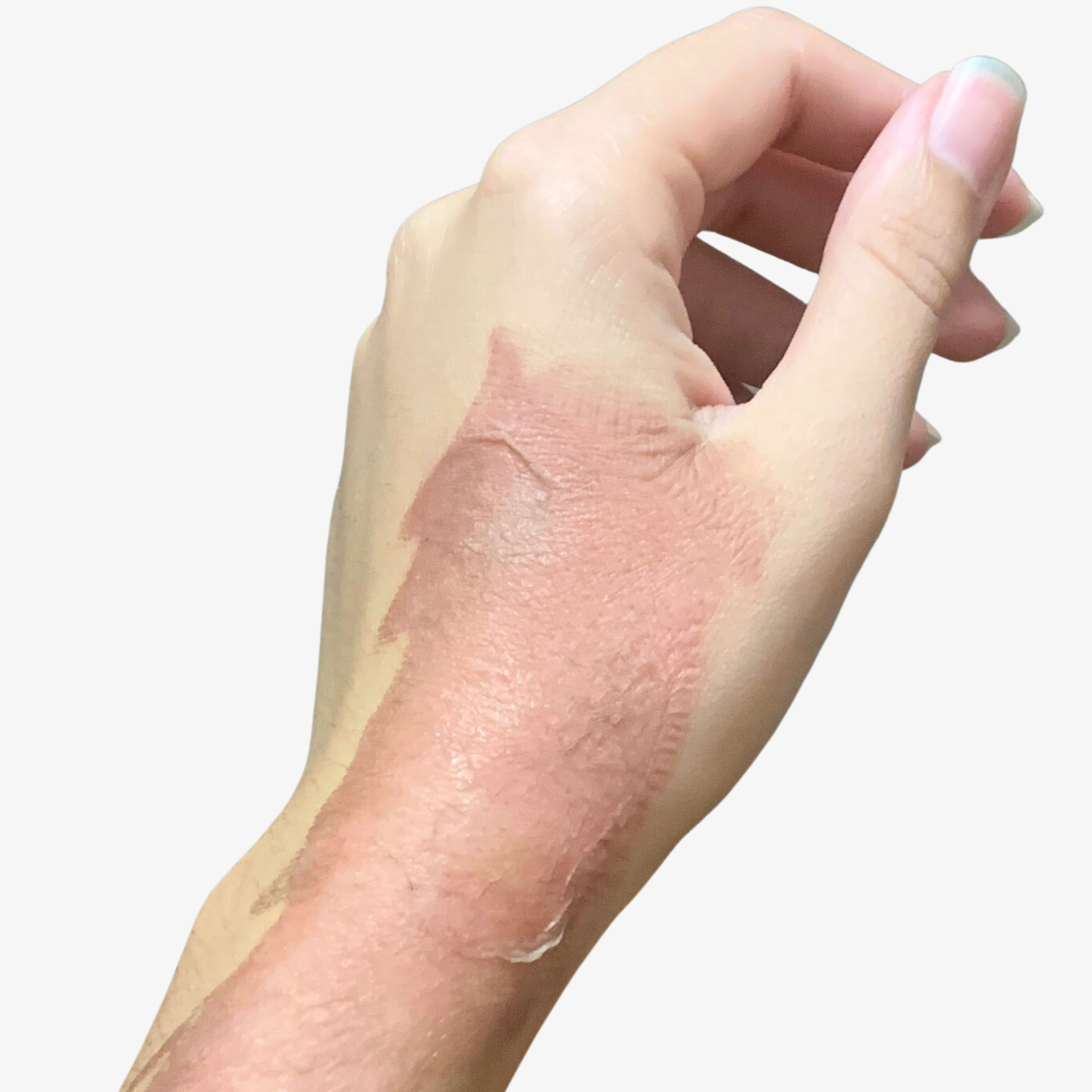 burn scar on hand 