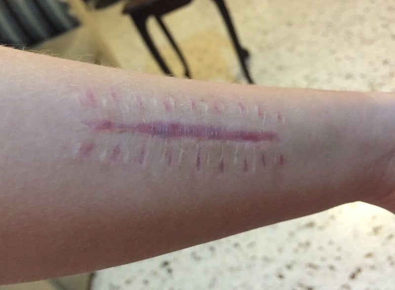 Ulnar Fracture Scar on Forearm before Treatment