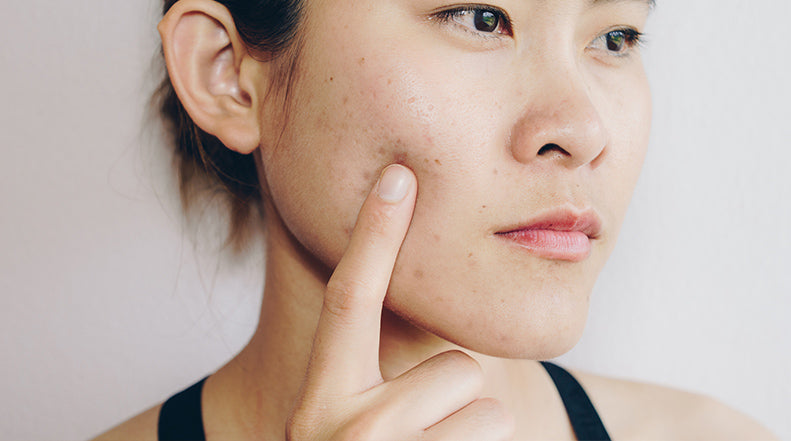 5 Things You Didn't Know About Acne Scars