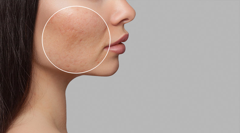 Can Silicone Gel Help Treat Acne Scars?