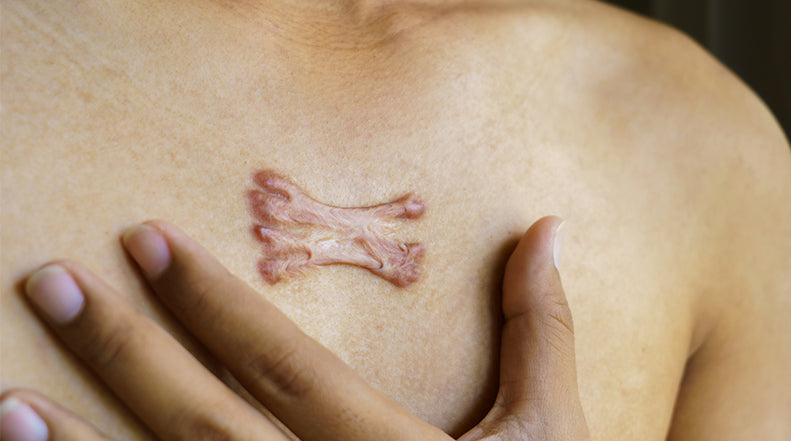 How to Break Up Scar Tissue: Effective Treatment Options