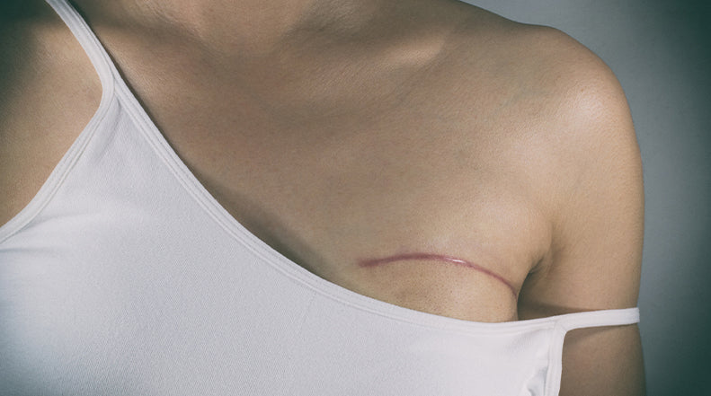 ScarWork at Estyn Wellbeing - Mastectomy scars are sensitive and