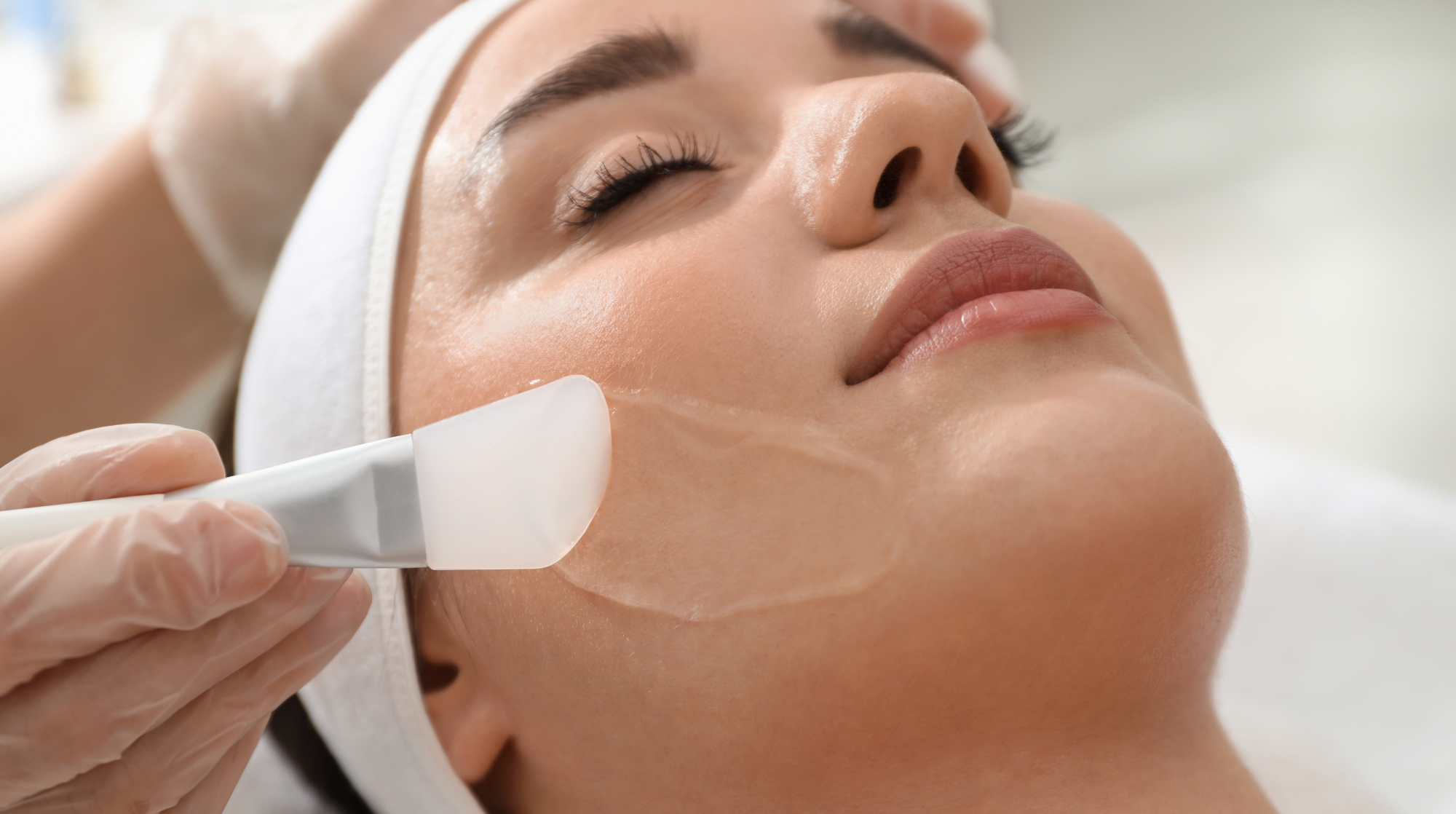 Chemical Peels: What are they and how do they effect Acne Scars?