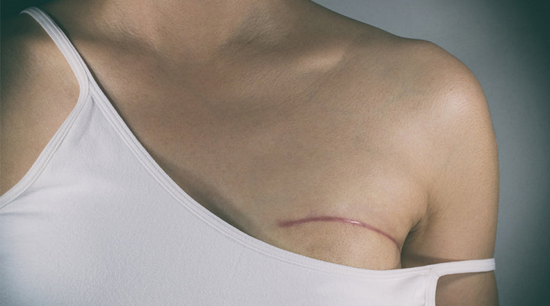 How to Treat the 4 Most Common Types of Scars