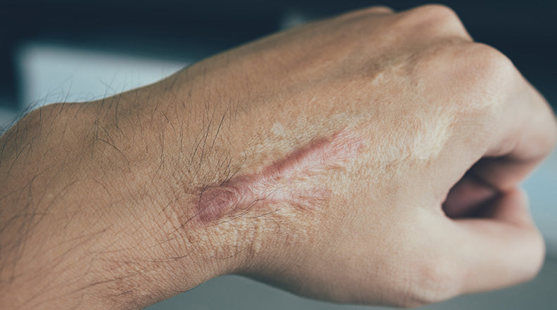 How to Treat Keloid Scars
