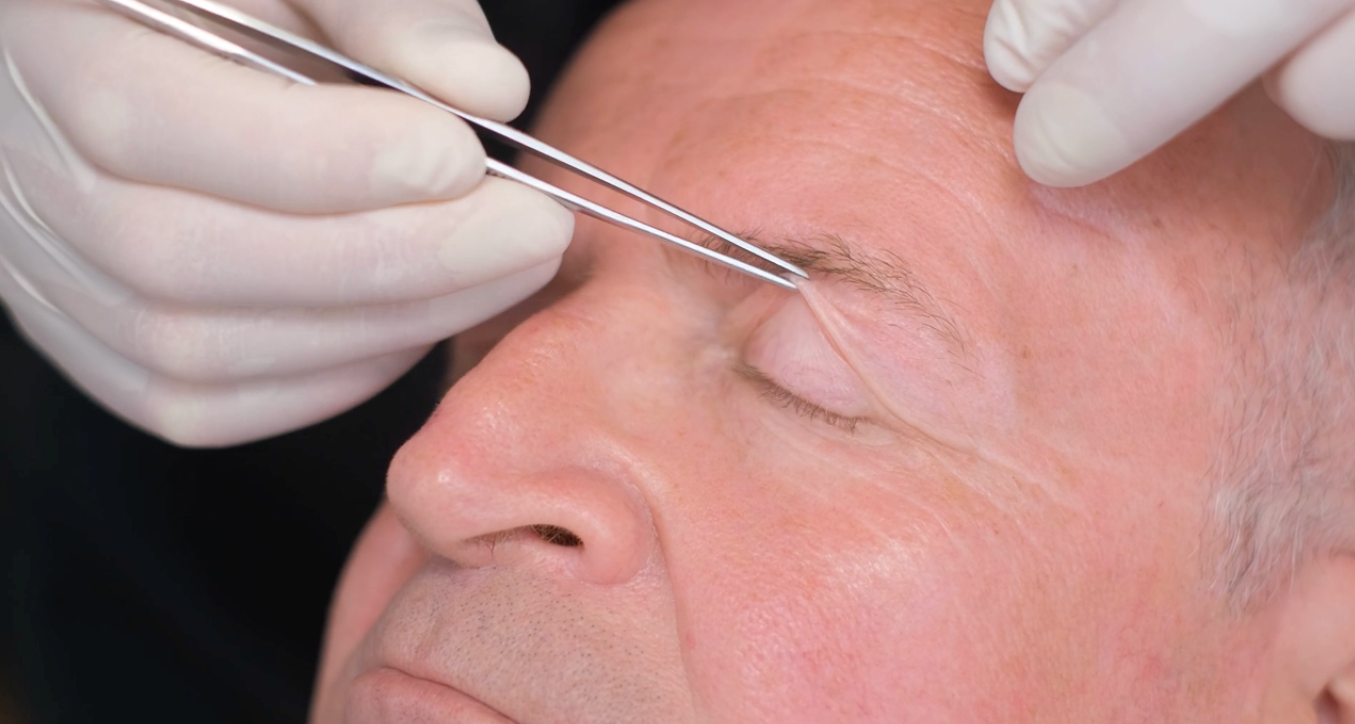 Eyelid surgery (blepharoplasty) recovery guide: learn about bruising, swelling, costs & scar care with silicone gels and tips for lasting results.